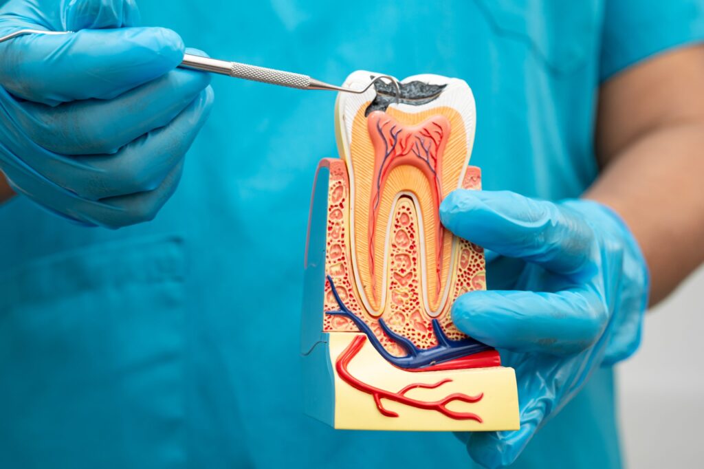 Root Canal Treatment